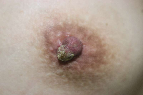 Figure 1 Photograph of the lesion on the left nipple. Erosion and crust on the left nipple.