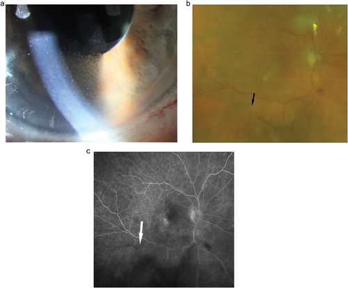 Figure 2. A. Mild anterior uveitis with discrete vision loss and mutton fat precipitates on the corneal endothelium six weeks after the second Brolucizumab injection which was well controlled under topical corticosteroids.B. Same patient, one week later. The posterior segment looks rather quiet; bleedings, vasculitic changes or vascular occlusion are not obvious despite a diffuse cellular vitreal infiltration. The dark arrow points to a small retinal vessel without obvious incoherence. C. Same patient, same visit as B.