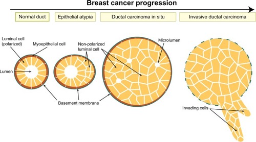 Figure 1 Breast tumor progression.