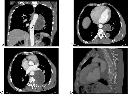 Figure 2 Coronal image reconstruction shows the close relationship between the cyst and descending aorta (black arrow) (A). Axial, post-contrast CT images at T5 level show chest wall asymmetry with multiple cystic lesions, with minimal wall enhancement (white arrow) (B). Axial Mediastinal window and sagittal bone window reconstruction show lytic lesions of posterior vertebral body, left pedicle and transverse process with adjacent ribs seen (short black arrow). There is widened left side neural foramen and perineural fatty effacement (white arrow) (C and D).
