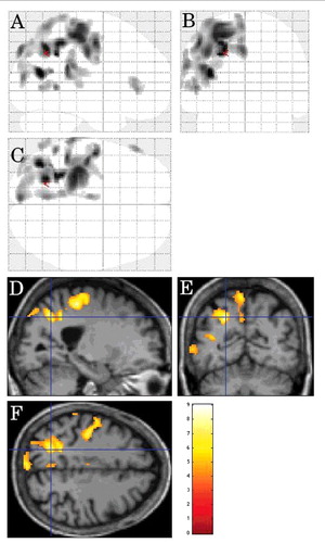 FIGURE 5. Inter-CJD SPM analysis, in the CJD patients with limb dystonia, showing left lateral parietal cortex and left lateral prerolandic frontal cortex hypometabolism (using a stringent level of significance of p<0.001 and an extent threshold of 100 voxels).