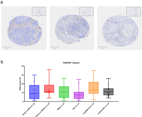 Figure 6. PDGFRB immunohistochemical staining of clinical tumor specimens. Staining settings: PDGFRB-DAB (brown) and Hematoxilin (blue). (a) Representative tumor cores of a tumor TMA, showing different patterns of PDGFRB in the tumor stroma. (b) Quantification of PDGFRB fraction (positive staining area as percentage tumor core area) showing overall representation of PDGFRB staining across different tumor types.