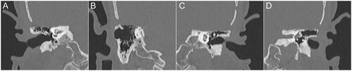 Figure 4. Postoperative CT demonstrated no recurrence of the meningoencephaloceles or cerebrospinal fluid leakage. (A,B) Postoperative CT of coronal sections showed good aeration in the attic, tympanic cavity, and mastoid of the right ear 3 years after the operation. (C,D) No protrusion from the cranium to the left middle ear cavity was identified. CT: computed tomography.