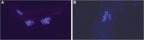 Figure 5 Fluorescence in situ hybridization staining of the epiretinal membrane using (A) an X (green arrows) chromosome probe and (B) X (green arrows) and Y (red arrows) chromosome probes.a