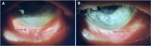 Figure 1 Arrows point to symblepharon formation seen inferiorly in the right (A) and left (B) eyes.