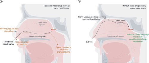 Figure 1. Differences in nasal drug delivery. Diagram of the nasal cavity illustrating nasal drug delivery through (A) traditional nasal routes into the lower nasal space and (B) INP104 delivery to the upper nasal space using Precision Olfactory Device (POD®) technology [Citation22,Citation54,Citation68,Citation69,Citation72,Citation74].