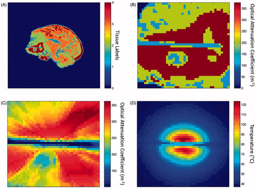 Figure 1. Process for predicting MRgLITT ablation region, beginning with pre-treatment T1W imaging. (A) A Gaussian mixture model applied to fibre-locating T1W imaging to segment the four distinct tissue types. (B) Optical attenuation coefficient values were applied within the distinct tissue labels. A representative region of interest used in temperature calculations is shown. (C) The average optical attenuation coefficient computed over the photon path from the source point. (D) A temperature map calculated from tissue properties using the Pennes bioheat equation. The tissue ablation region was predicted by a maximum temperature greater than 57 °C.