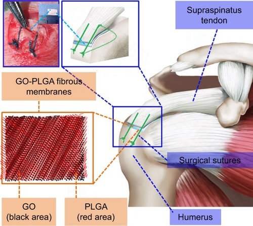 Figure 1 Diagram of transosseous supraspinatus tendon repair with GO-PLGA fibrous membranes.Abbreviations: GO, graphene oxide; PLGA, poly(lactic-co-glycolic acid).