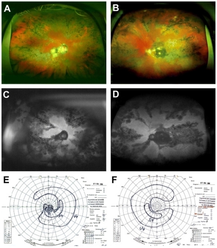 Figure 4 Case 4: (A, B, C, and D) Optomap color imaging (A and B), wide-field FAF (C and D) of the right eye and left, and corresponding visual fields (E and F). In both eyes, pigmented scars at the posterior pole and the periphery can be seen in Optomap color fundus imaging. FAF reveals distinct serpiginous and geographic areas of reduced FAF in both eyes. These findings correspond to visual field defects found in Goldmann perimetry.