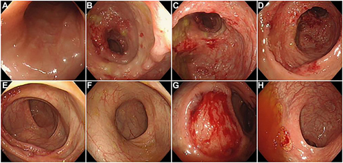 Figure 2 (A) Terminal ileum; (B) cecum; (C) ascending colon; (D) ascending colon; (E) transverse colon; (F) descending colon; (G) sgmoid colon; (H) rectum.