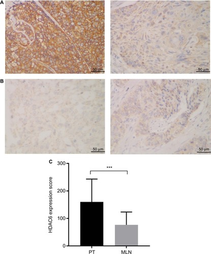 Figure 1 Lower HDAC6 expression was exhibited in MLNs than in the corresponding esophageal squamous cell cancer PT.Notes: (A) Representative immunohistochemical staining of a patient whose HDAC6 expression was higher in the PT (left) than in MLNs (right). (B) Representative immunohistochemical staining of a patient whose HDAC6 expression was lower in the PT (left) than in MLNs (right) (magnification ×400). (C) Paired comparison of HDAC6 staining scores of PTs and MLNs. ***P<0.001, Wilcoxon matched-pair signed-rank test.Abbreviations: HDAC6, histone deacetylase 6; MLN, metastatic lymph node; PT, primary tumor.