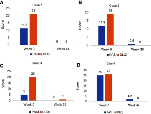 Figure 2 Psoriasis Area Severity Index (PASI) and Dermatology Life Quality Index (DLQI) scores before and after treatment with brodalumab. (A) Case 1, (B) Case 2, (C) Case 3, (D) Case 4.