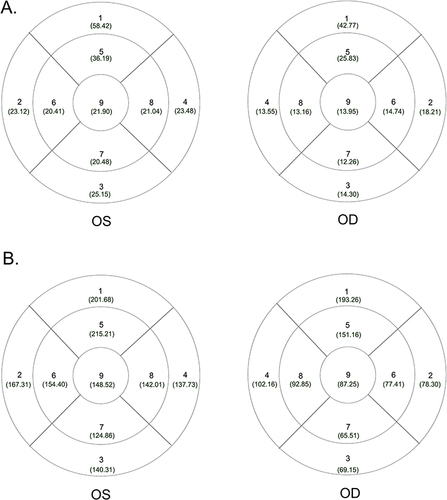 Figure 3 Lens zone numbering method of the mounted spectacle from the digital strain viewer image in a different mounting state (interior view). The tested lens was divided into nine zones by three concentric circles and two intersecting lines. The diameters of the concentric circles are 3, 6, and 9 mm. The angle between the two lines is 90°. The medians of the internal lens stress in the different zones are placed inside the brackets below the zone number. (A) Loose mounting. (B) Tight mounting.