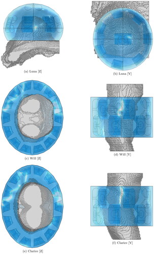 Figure 2. Schematic of the patient models and the applicator. The water bolus is shown in blue. The patient model is shown in gray. (a) and (b) show the 8-channel spherical applicator for Luna. (c) and (d) show the 14-channel two-row cylindrical applicator for Will. (e) and (f) show the 14-channel two-row cylindrical applicator for Clarice.