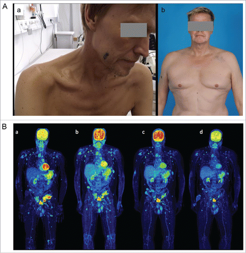 Figure 1. (A). Cachectic 56 y old patient with extensive stage IV disease before start of vemurafenib (a) and after 6 mo of combination treatment with vemurafenib and ipilimumab (b). He presented with an ECOG 4 after enlarged hemicolectomy with ileostoma because of metastases induced small and great bowel ileus. Under the combination treatment the patient gained 30 kg of weight and is back to normal day life. (B). PET-CT scans before start of ipilimumab (a; after 4 mo of vemurafenib treatment, LDH decreased to normal serum levels), after four doses of ipilimumab (b; after 7 mo of vemurafenib treatment), at discontinuation of vemurafenib (c; one year after treatment start) and at last staging (d; 2.5 y after start of treatment and 1.5 y without any treatment).