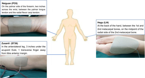 Figure 1 The location of the acupoints for transcutaneous electrical acupoint stimulation.