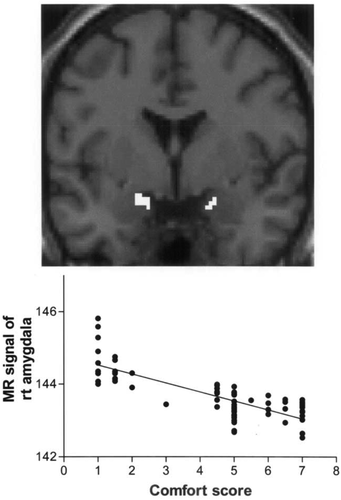 Figure 1. (Top) The areas that showed significant covariation of BOLD signals with cold discomfort in every subject, superimposed on the high-resolution MRI of the individual unrelated to the study. In all subjects, only the bilateral amygdala showed a negative correlation with the comfort score. (Bottom) Significant correlation of MR signal change by individual analysis. Normalized MR signal (relative to the global signal which was set to 100) in the right amygdala was plotted against the comfort score. The regression line was y = −2.46x + 144.8, X = 0.63, F(1,68) = 115.7 [P < 0.0001, F test). Adapted from [Citation13]