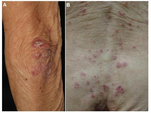 Figure 2 Psoriasis plaques showing scaly keratotic erythemas on the elbow (A) and back (B) under nivolumab therapy.
