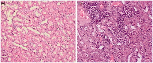 Figure 1. Histopathological findings of renal tissue after exposure to contrast media (200×, hematoxylin–eosin). (A) Degeneration of tubules. (B) Interstitial inflammation, slight tubular dilatation, and congestion.