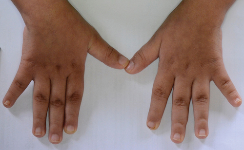 Figure 2. Right and left hand.