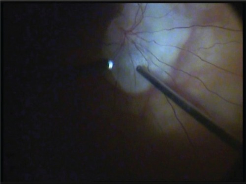 Figure 2 Intraoperative photograph during drainage of subretinal fluid through juxtapapillary microhole in Case 4. Note proximity of drainage site to retinal vein.