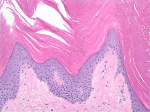 Figure 3 Histopathology slide of the punch biopsy specimen.