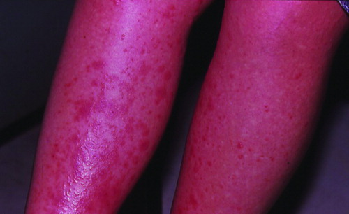Figure 1.  Extensive exanthemous lesions in the lower extremities in a pregnant woman at 31 weeks of gestation, which developed shortly after eating lobster meat.