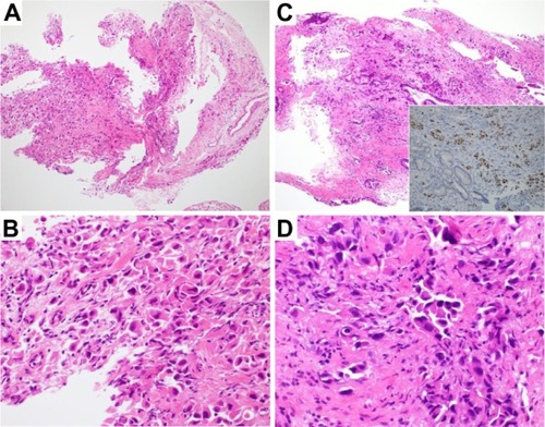 Figure 2 Pathological specimens and cholangioscopic images.