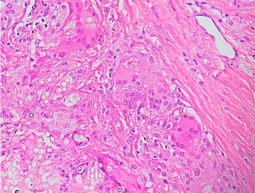 Figure 7 Histological section of a patient with lobomycosis.