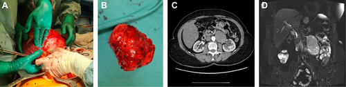 Figure 1 PEComa tumor radiological imaging and resection. (a) Intraoperative picture of PEComa resection, (b) PEComa after resection, (c) CT scan of PEComa, (d) MRI scan of PECma.