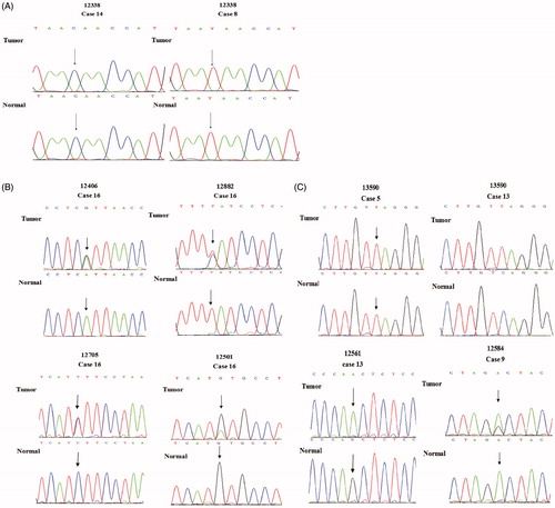 Figure 1. In the sequencing map, SNP and SNV in gastric cancer tissue and adjacent normal tissue. (A) The nucleotide at np 12338 is SNP in present study. In gastric cancer tissue and adjacent normal tissue of No. 14 or No. 8, the nucleotide at np 12338 was the same. There were different nucleotides at np 12338 in No. 14 and No. 8 normal tissue samples. (B) In the sequencing map, double peaks were detected at np 12406, 12882, 12705, 12501. They were SNVs. In No. 16 gastric cancer tissue sample, there are two kinds of nucleotides A and G at np 12406, and there are two kinds of nucleotides C and T at np 12882; T and C were detected at np 12705 in No. 16 gastric cancer tissue; G and A are detected at np 12501 in No. 16 gastric cancer tissue samples; G is detected at np 12501 in normal tissue. (C) It is an SNV at np 13590 in No. 13 paired tissue samples (sequencing map of complementary DNA strand), all of A at np 13590 in normal tissue mutate to A in gastric cancer tissue; in No. 5 paired tissue samples (sequencing map of complementary DNA strand), only A is detected in both of gastric cancer tissue and normal tissue. it is a wildtype at np 13590; G is detected at np 12561 in No. 13 adjacent tissue sample, and whole G mutate to A in gastric cancer tissue sample. G and A are detected at np 12584 in No. 9 gastric cancer tissue samples; A is detected at np 12584 in normal tissue. Part of A at np 12584 mutate to G in gastric cancer tissue sample.