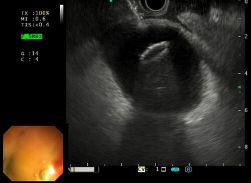 Figure 3 Endoscopic ultrasound-guided gallbladder drainage (EUS-GBD) with first flange opening of the electrocautery lumen-apposing metal stent (EC-LAMS).
