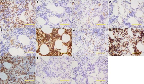 Figure 3 Immunohistochemical of pleural mass revealed EMH.Notes: Immunohistochemical staining ×200. Scale bar: 200 µm. (A) CD15+; (B) CD20+; (C) CD34+; (D) CD30+; (E) CD38+; (F) CD68+; (G) CD7+; (H) Ki67+ (80–90%); (I) lysozyme+; (J) CK5−; and (K) CK7−.Abbreviation: EMH, extramedullary hematopoiesis.