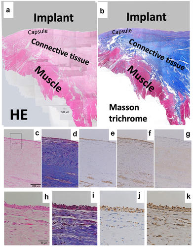 Figure 4. Histology of revision by KMLS. (a) Micrograph of hematoxylin–eosin (HE)-stained section; ×40 image. (b) Micrograph of Masson’s trichrome-stained section. Red color indicates muscle tissues. (c) Micrograph of hematoxylin–eosin (HE)-stained section; ×100 image. (d) Micrograph of Masson’s trichrome-stained section; ×100 image. (e) Micrograph of section with immunohistochemical (IHC) staining for CD68; ×100 image. (f) Micrograph of section with IHC staining for vimentin; ×100 image. (g) Micrograph of section with IHC staining for collagen type I; ×100 image. (h) Micrograph of HE-stained section; ×400 image. (i) Micrograph of Masson’s trichrome-stained section; ×400 image. (j) Micrograph of section with IHC staining for CD68; ×400 image. (k) Micrograph of section with IHC staining for vimentin; ×400 image.