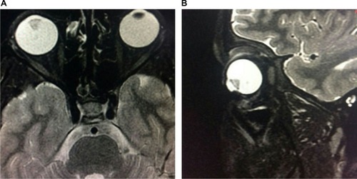 Figure 2 (A, B) T2W axial and sagittal images show hypointense lens material in the vitreous cavity.