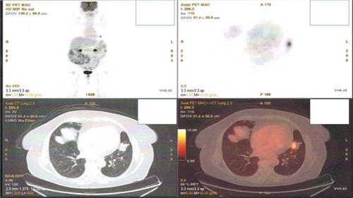 Figure 1 Main lesion with positive positron emission tomography–computed tomography (PET-CT).
