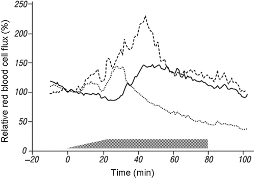 Figure 1. Variability of tumour perfusion response to localised 44°C hyperthermia. Curves show relative red blood cell flux at three different sites within a single tumour at comparable temperatures. The shaded bar shows the time of hyperthermia application (modified from Vaupel et al. Citation[47]).