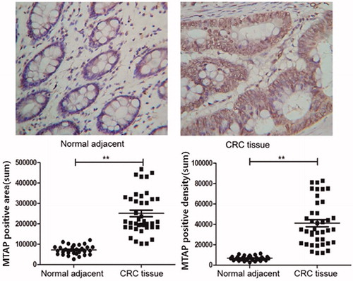 Figure 3. High protein expression of MTAP in colorectal cancer. The expression of MTAP was significantly increased in colorectal cancer tissues compared to paracancerous tissues by IHC. *indicated p < .05.