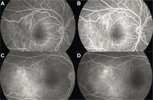 Figure 2 Case 1. Fluorescein angiography sequence. Pronounced choroidal folds and early hyperfluorescence, with leakage and some pin points.