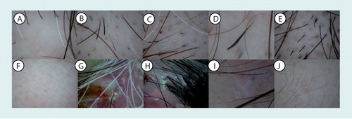 Figure 2. Trichoscopic images of characteristic features in various kinds of hair loss.(A) loss of orifices in linear scleroderma (sclerodermie en coup de sabre), (B) broken hairs, (C) black dots, (D) tapering hairs (exclamation mark hairs), (E) yellow dots and (F) short vellus hairs in alopecia areata, (G) micropustules and (H) hair tufting with six or more hairs in folliculitis decalvans/tufted folliculitis, (I) comma hairs in tinea capitis, and (J) short vellus hairs in androgenetic alopecia.