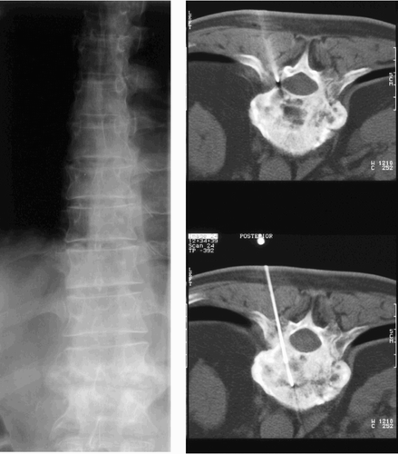 Figure 2. Pretreatment radiograph (left) and CT-guided biopsy (right) from a patient treated nonoperatively.