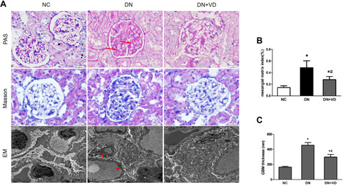 Figure 4 Calcitriol attenuates histological abnormalities of diabetic nephropathy. SD male rats were intraperitoneally injected with 60 mg/kg streptozotocin. After 3 days, the rats with STZ treatment were garaged with 0.1μg/kg/d calcitriol or vehicle solution daily for consecutive 18 weeks. Kidney tissues were collected for histology at 18th week. (A) Representative images of Periodic Acid-Schiff (PAS) staining, Masson staining and electron microscopy (EM) of three groups of kidney tissues. Arrows indicate the expanded mesangial matrix in glomerular area and arrowheads indicate the enhanced thickness of the glomerular basement membrane and podocyte effacement. (B) Glomerular mesangial matrix index (%) of three groups. (C) Quantifications of mean GBM thickness. Values are mean ± SD (n=6). Significance: *P<0.05 vs NC group, # P<0.05 vs DN group.