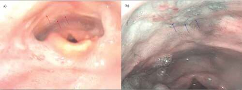 Figure 2. Patient with T1N2A oropharyngeal cancer status post definitive chemoradiation. (a) Distal chip video laryngoscopy revealed post-treatment radiation edema with no evidence of mucosal disease delineated by red arrows. (b) NBI revealed a mucosal abnormality delineated by blue arrows. Biopsy was consistent with high-grade dysplasia. Image is borrowed with permission from Dr Peter Belafsky.