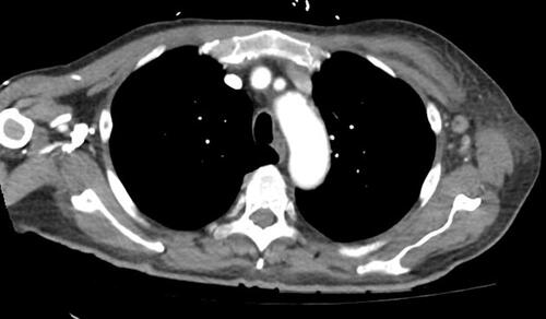 Figure 2 The patient’s CT imaging of the thoracic region showed enhancement of the left axillary lymph node.