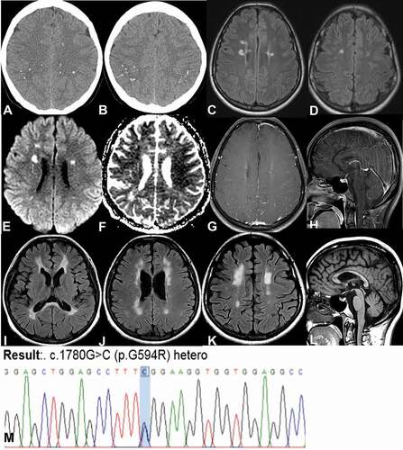 Figure 1. Brain computed tomography (a, b) and serial brain magnetic resonance imaging (c-h at asymptomatic state and I-L 3 years later) and genetic analysis (m).
