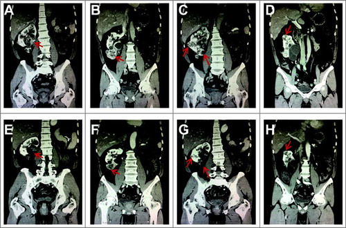 Figure 2. Computed tomography (CT) scans from Patient 2. The CT scans show multiple right renal cell carcinomas (RCCs) before and after sunitinib treatment, including the masses around the renal hilum (A and E), lower ventral (B and F), dorsal, lower dosal (C and G), superior pole (D and H). Red arrows indicate the masses.
