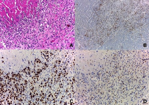 Figure 2 H&E section of myocardial tissue with necrotic focus containing dense lymphocytic infiltrates (A); immunohistochemistry of lymphoid component disclosing PD-1 cells (B), CD8 (C), and CD4 lymphocytes (D). 100× magnification.