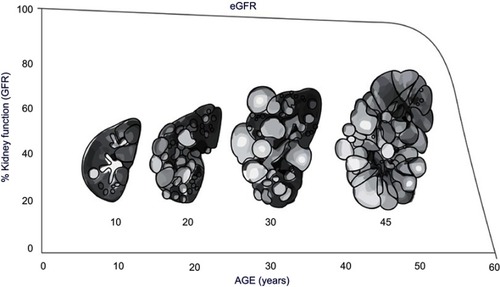 Figure 2 Increase in kidney size and decrease in kidney function estimated by eGFR Correlated with age.