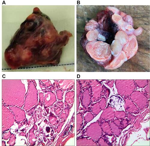 Figure 2 (A and B) Thyroid and thyroid profile; (C and D) multinodular goiter (HES ×400).