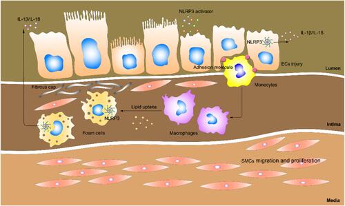 Figure 1 Schematic of atherogenesis. Risk factors such as high cholesterol, hyperglycemia, and smoking are contributors of atherogenesis. These activators gain access to the intima via damaged endothelial cells (ECs). Damaged ECs trigger NLRP3 inflammasome activation, IL-1β and IL-18 release, thus further leading to inflammation. On the other hand, damaged ECs express adhesion molecules that capture the monocytes, which get into the intima and differentiate into macrophages. Macrophages ingest lipid and turn into foams cells, which gradually die and release their contents (such as IL-1β and IL-18), giving rise to the inflammatory response. The inflammatory response stimulates the migration and proliferation of smooth muscles cells (SMCs), which aggregate in the plaques to form fibroproliferative lesions.